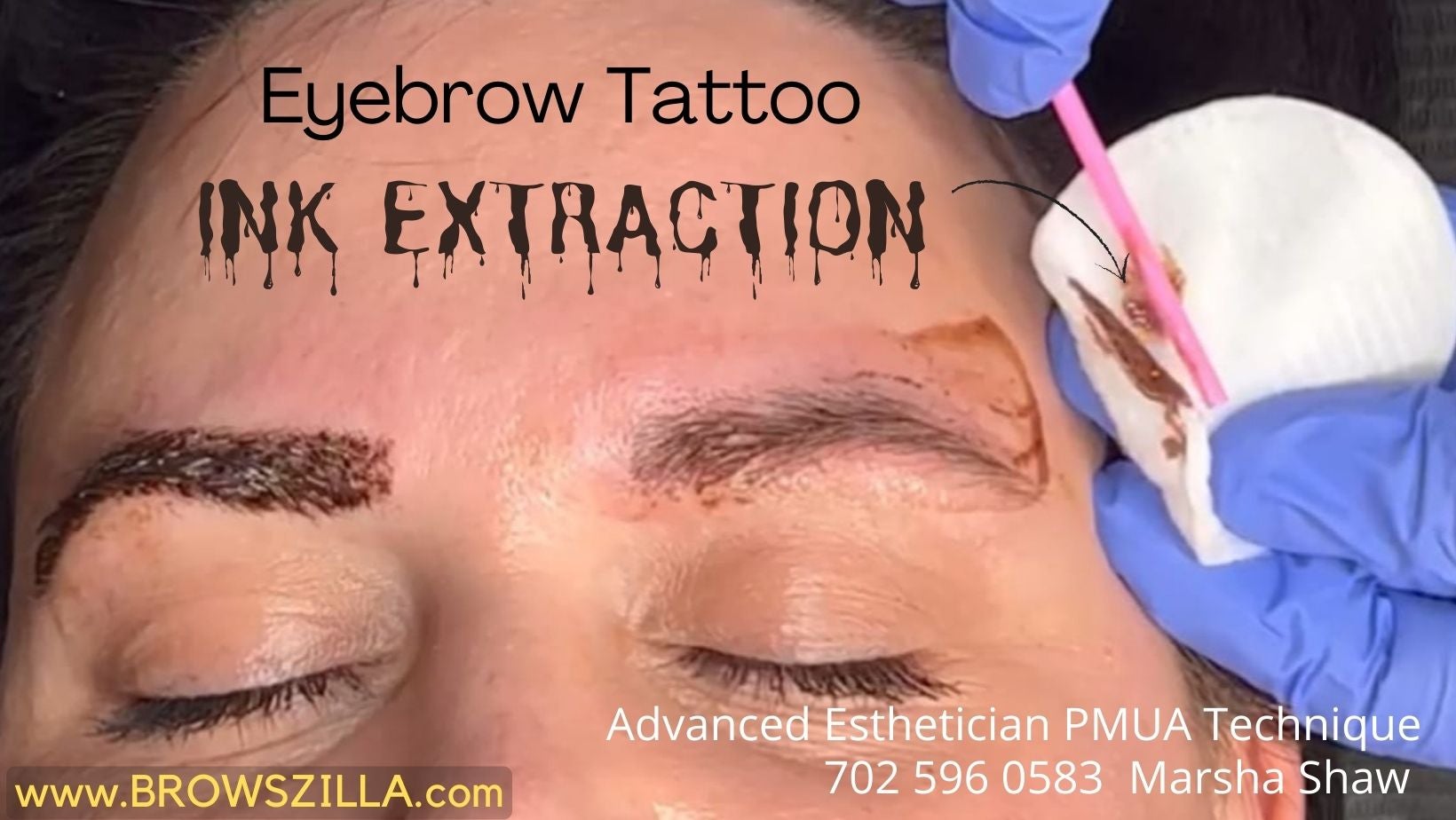 Dermato  Free FullText  Laser Removal of Cosmetic Eyebrow Tattoos with a  Picosecond Laser