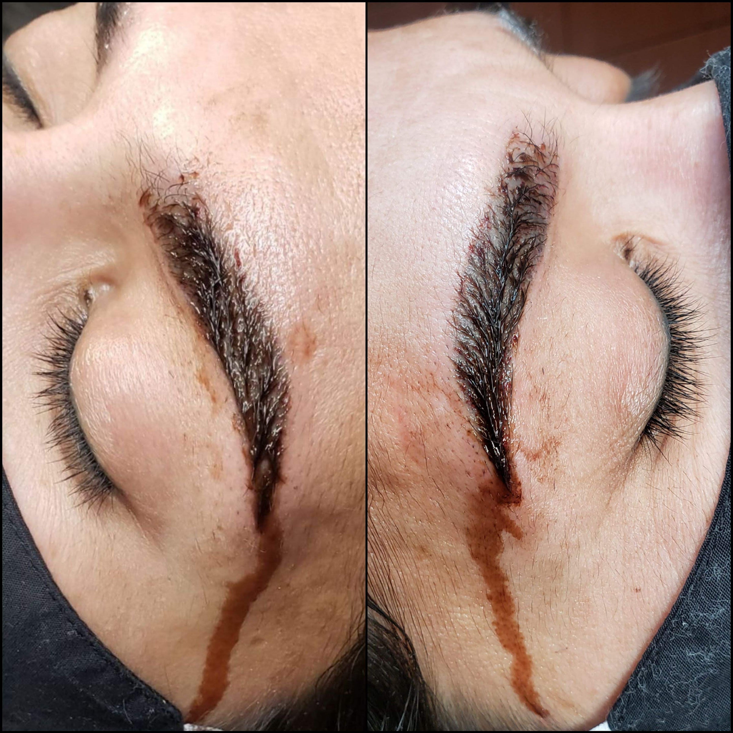 Permanent Makeup Eyebrow Ink Removal
